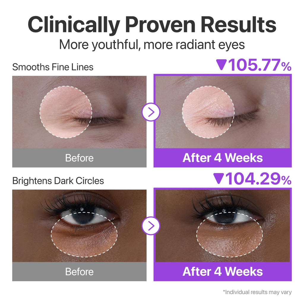 Before and after effects of eye cream on fine lines and dark circles with clinical data.